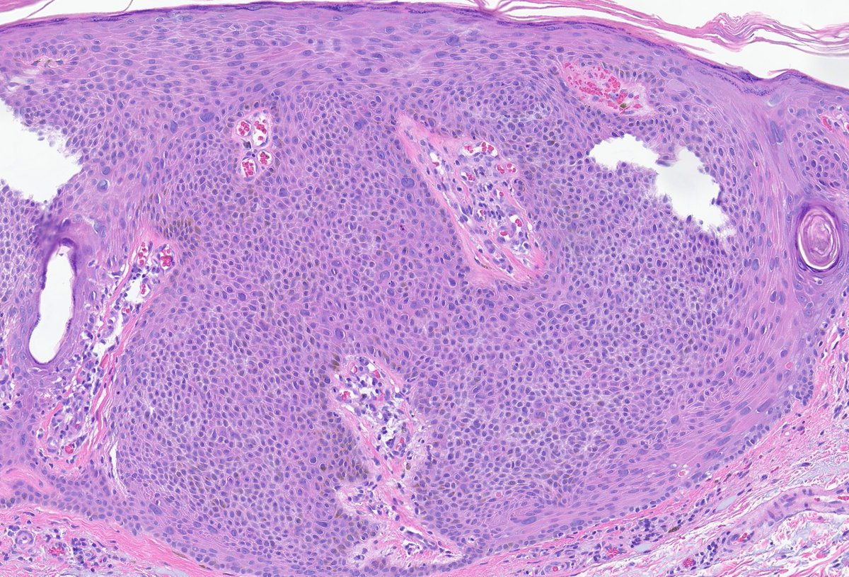 what do you make these large 'atypical' cells in an irritated SK? #dermpath @MarcelaSaebL @PIorfino @et565 @david_terrano @mccalmo @gonzadetoro @ArjunRamaiya1 @CakePath @AadilAhmedMD @redsnapperpath @DrGeeONE @kis_lorand