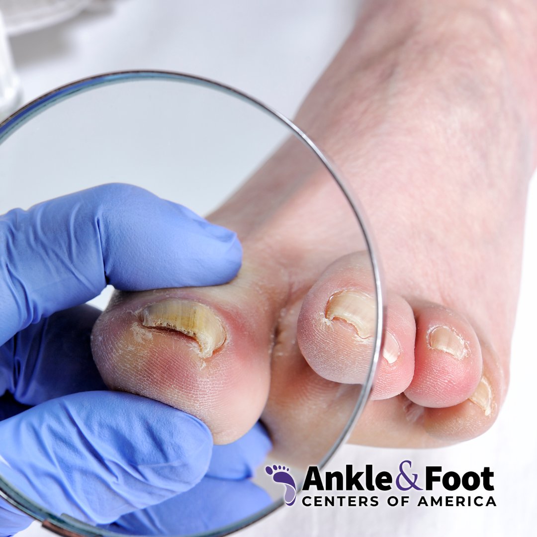 Battling nail fungus? 🍄 Let your Franklin podiatrist help you clear it up. Schedule an appointment with us and take the first step towards healthier nails. 💅 #NailFungus #AnkleAndFootCenters #FranklinPodiatrist