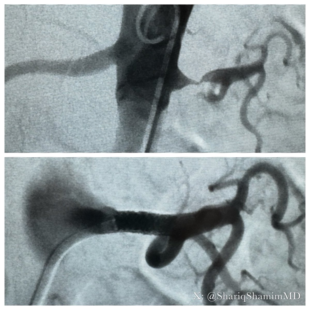 6 antihypertensives with uncontrolled BP. 30 mins later off 💊💊💊! #cardiotwitter don’t ignore simple secondary HTN with up with duplex.