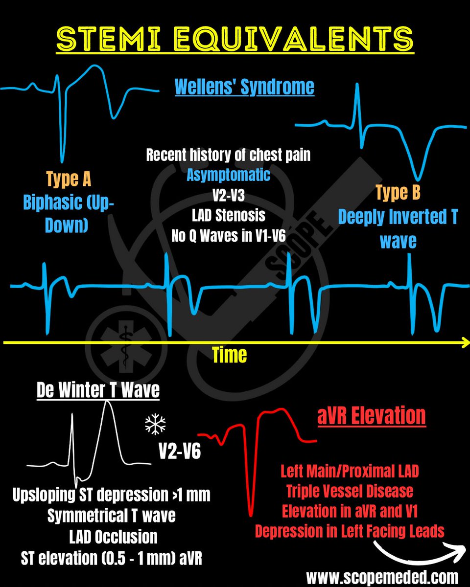 scopeducation's tweet photo. STEMI Equivalents https://t.co/C12Z2J135k