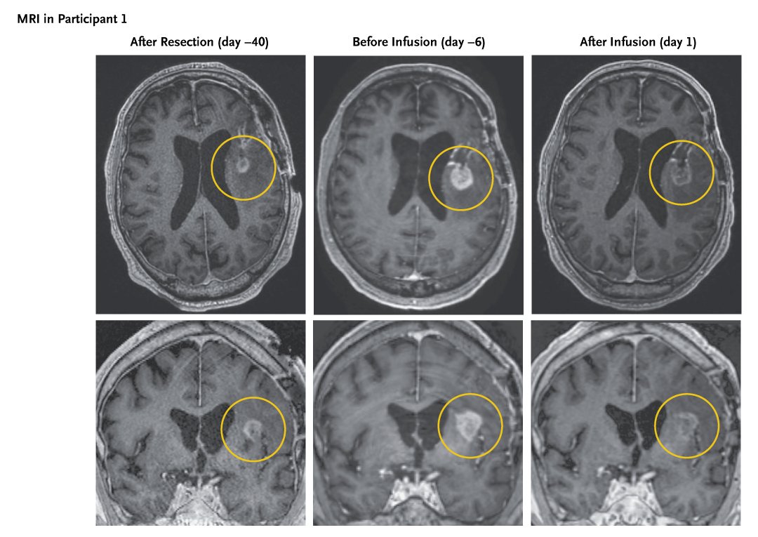 A novel CAR T-cell therapy directed at EGFRvIII with a secretable EGFR T-cell engager produced rapid responses in three patients with recurrent glioblastoma, but the responses were transient in two of the three. Read the Brief Report for the full study: nej.md/3VnjUIq