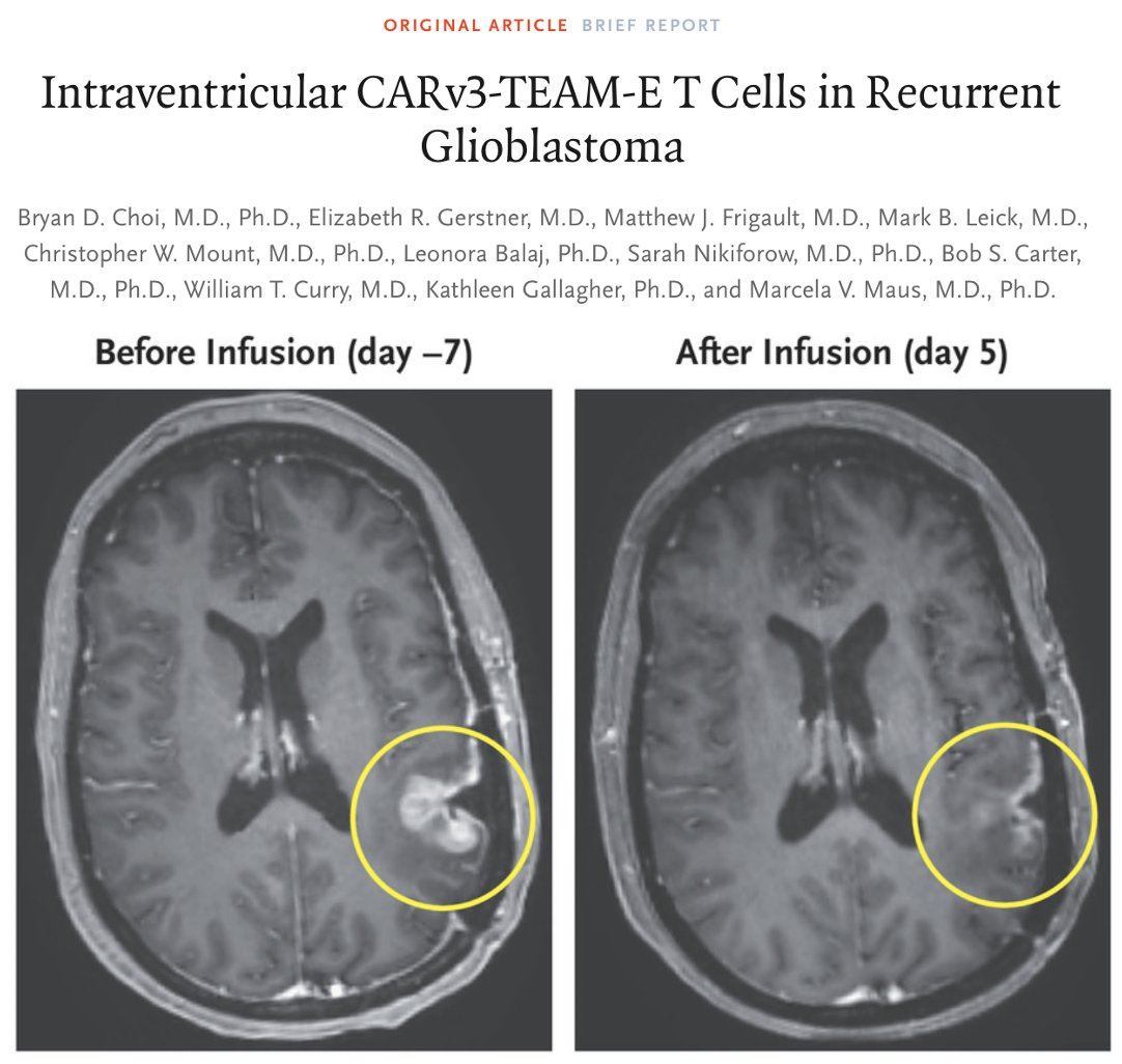 Today, @NEJM published our clinical study of a novel #CARTCell in patients with #Glioblastoma. Early results with CARv3-TEAM-E suggest safety and bioactivity. Special thanks to all collaborators @MGHNeurosurg and @MGHCancerCenter! nej.md/3VnjUIq