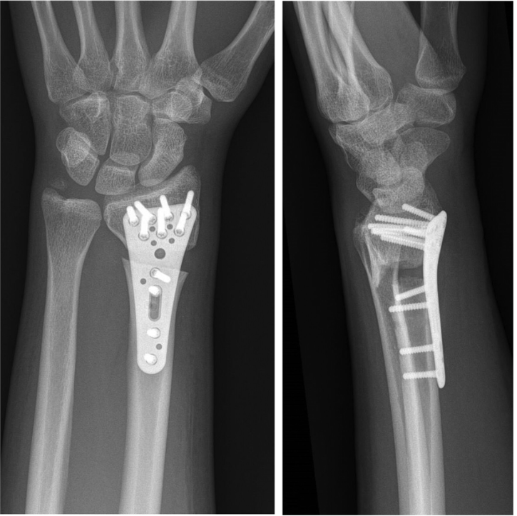 Managing distal radius malunion presents challenges in surgical practice, particularly in deciding between various treatment modalities such as bone grafting and corrective osteotomy. Let's delve into this topic with a threaded 🧵discussion