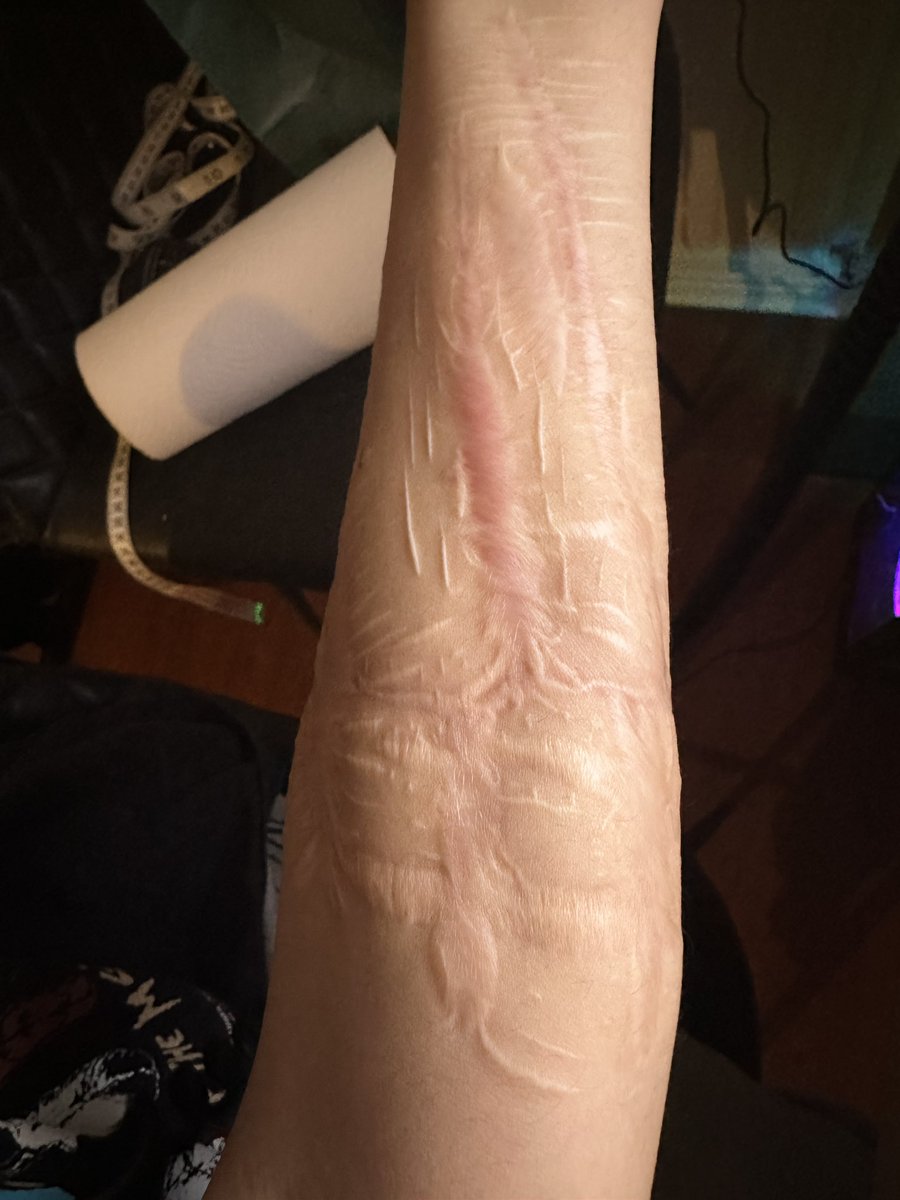my arm scars (excluding the most recent one (last june) that’s not captured since it’s on the side)