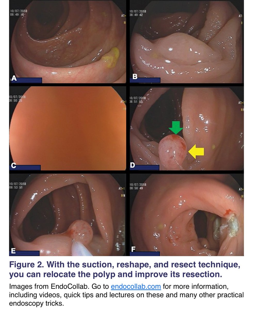 ✅ With this technique you’ll never loose a flat polyp from your sight 👀 again 👍🏻