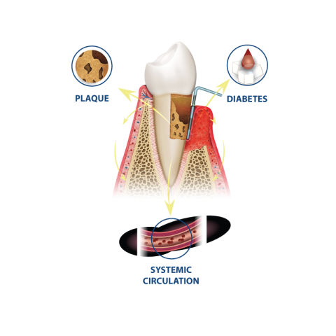 SMLGlobal's tweet photo. THE GATEWAY TO ORAL HEALTH:
ADDRESSING THE BLOOD-SUGAR BURDEN OF TYPE-2 DIABETES
The American Dental Association notes that diabetes and periodontal disease have a “bidirectional” relationship#oralhealth #oraklenz 
https://t.co/vMopyYNnhP https://t.co/Uvg9cxRvFk