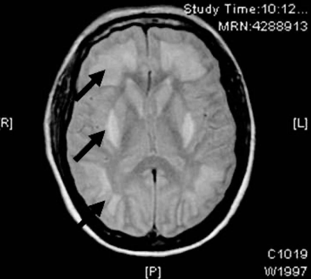 ardila11 (@alvaroardilao) on Twitter photo RM cerebral que muestran necrosis bilateral y simétrica a nivel de ambos putámenes y sustancia blanca subcortical, característico de in- toxicación por metanol. Siempre es prevenible. RM cerebral que muestran necrosis bilateral y simétrica a nivel de ambos putámenes y sustancia blanca subcortical, característico de in- toxicación por metanol. Siempre es prevenible.