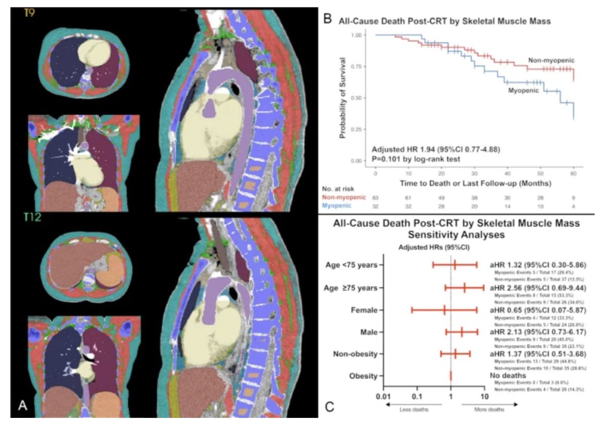 🚨Latest #FreeRead in <a href="/JICE_EP/">JICE</a>

Preimplant Myopenia and Clinical Outcomes Among Patients with Heart Failure Undergoing Cardiac Resynchronization Therapy

📖🧐rdcu.be/dA8p2

by @SaeidMirzaiDO, Maximilian C. Volk, <a href="/ianpersits/">Ian Persits, DO, MS</a>, Kunaal S. Sarnaik, @_LAM_PHD, Po-Hao Chen,