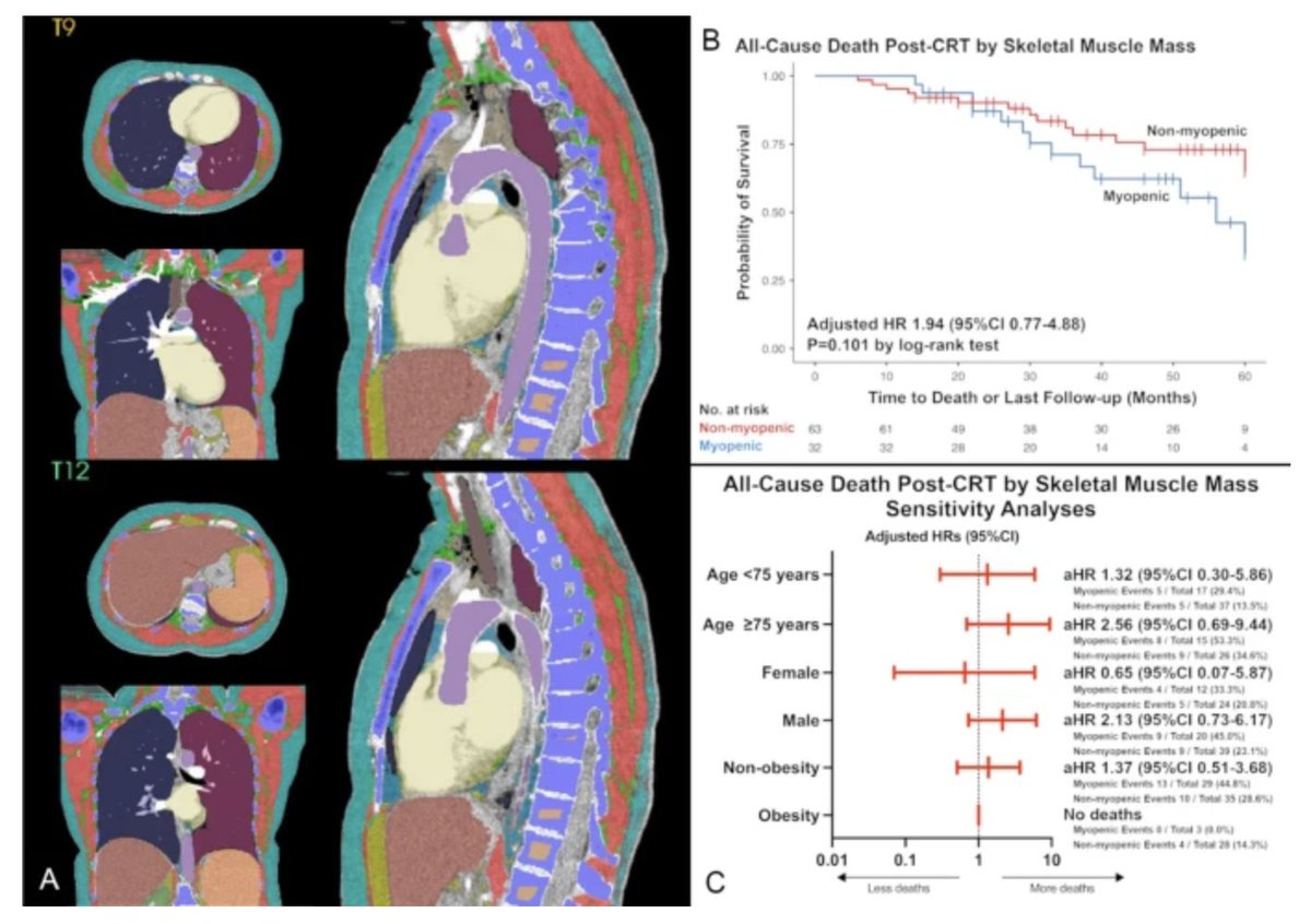 🚨Latest #FreeRead in @JICE_EP Preimplant Myopenia and Clinical Outcomes Among Patients with Heart Failure Undergoing Cardiac Resynchronization Therapy 📖🧐rdcu.be/dA8p2 by @SaeidMirzaiDO, Maximilian C. Volk, @ianpersits, Kunaal S. Sarnaik, @_LAM_PHD, Po-Hao Chen,…