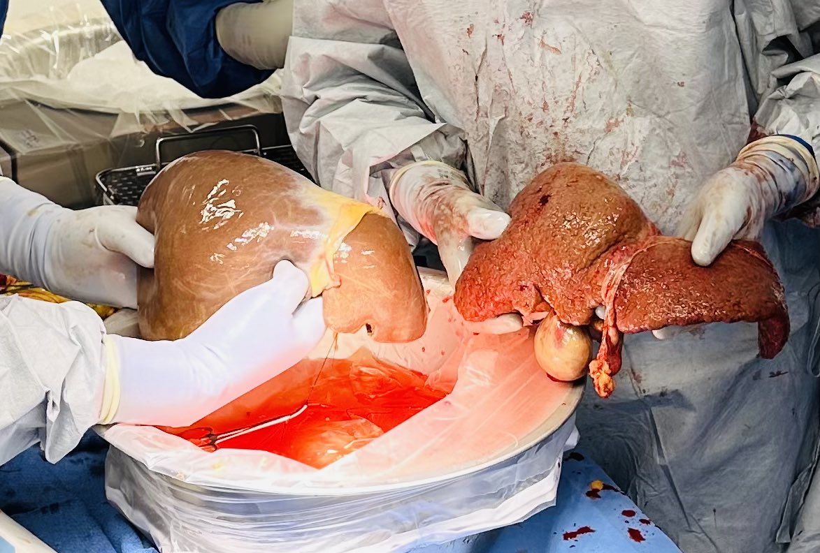 Adarsh Vijay, MD, FACS (@dradarshvijay) on Twitter photo Organ Donation: Life goes onā¦. Pass it on⦠<a href="/ASTSChimera/">ASTS</a> <a href="/SAGES_Updates/">SAGES is in Tampa in 2026!</a> <a href="/Tulane_Surgery/">Tulane - Department of Surgery</a> <a href="/TulaneMedicine/">Tulane Medicine</a> <a href="/TeamSurgery247/">TeamSurgery</a> Organ Donation: Life goes onā¦. Pass it on⦠<a href="/ASTSChimera/">ASTS</a> <a href="/SAGES_Updates/">SAGES is in Tampa in 2026!</a> <a href="/Tulane_Surgery/">Tulane - Department of Surgery</a> <a href="/TulaneMedicine/">Tulane Medicine</a> <a href="/TeamSurgery247/">TeamSurgery</a>