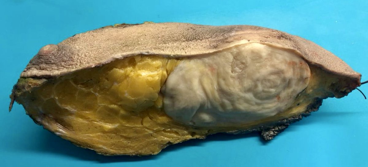 vintage81106614's tweet photo. The art of grossing. A 72 yo woman with a 5x4cm right breast tumor. Final DX.Fibromatosis-like Metaplastic Carcinoma.#Pathology #Pathresidents #Breastpath #PATHtweets https://t.co/O64Izo3Pi0