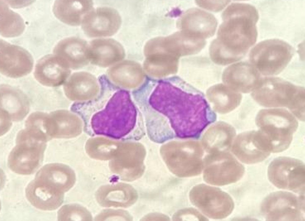 36/♂️/ presents with fever and left cervical lymphadenopathy x 2 weeks 😭

Liver palpable, 2 cm

Hgb: 130g/L
WBC: 8.8
Plt: 265
AST / ALT: 5x ULN 😲

Peripheral blood smear 👇🏻

Smear findings?
Ddx?
Management?

#MedTwitter