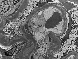 kdjhaveri's tweet photo. #nephronpower https://t.co/uuUWPwrNY5 In the News: Dense Deposit Disease and ApoE- the new connection https://t.co/tE8uiHX0FO