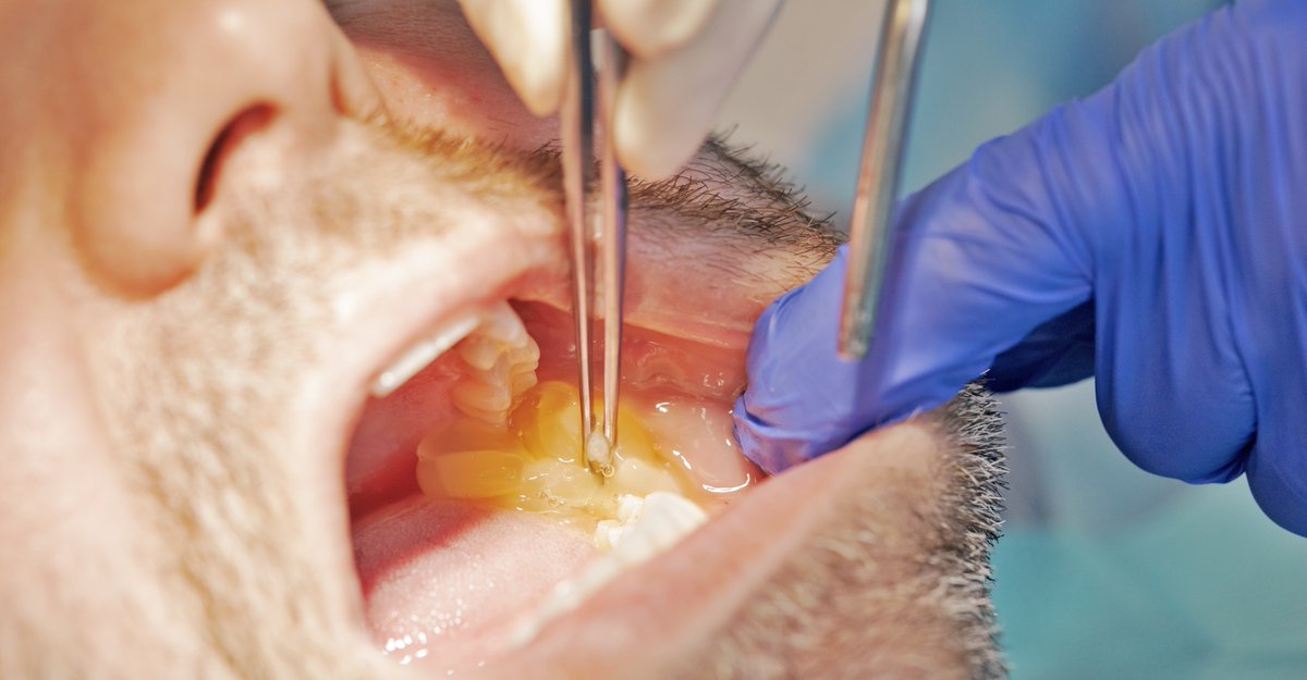 BTIBiotech's tweet photo. Conoce las aplicaciones de la tecnología PRGF-ENDORET® en cirugía oral:
🔹 Tratamiento atrofia maxilar
🔹 Injertos y regeneración periodontal
🔹 Cirugía implantológica
🔹 Alveolos postextracción
🔹 Reducción riesgo osteonecrosis
👉 https://t.co/AcVyryKloz
#PRGF #Endoret https://t.co/jApOMKyr3f