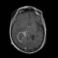 JNeurosurgical's tweet photo. All-cause and tumor-specific mortality trends in elderly primary central nervous system lymphoma (PCNSL) patients: a surveillance, epidemiology, and end results (SEER) analysis

https://t.co/vQwOFAZSg0

#JNSS #neurosurgery #edizioni_minerva_medica #surgeon #neurosurgeon #lymphoma https://t.co/LxCc5g0Fnz