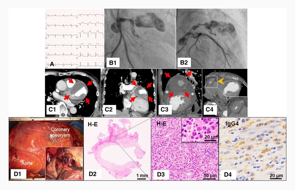 EHJ-IMP Editor-in-Chief (@ehjimpeic) on Twitter photo Goodmorning #EHJIMP with this very interesting case by Dr Honda et al on a patient with IgA disease & giant coronary aneurysm who presented with STEMI ➡️ academic.oup.com/ehjimp/article… <a href="/JGrapsa/">Julia Grapsa MD, PhD</a> <a href="/ShehabAnwer/">Shehab Anwer, MD</a> <a href="/EZancanaroMD/">Edoardo Zancanaro MD</a> <a href="/ESC_Journals/">European Society of Cardiology Journals</a> <a href="/escardio/">European Society of Cardiology</a> <a href="/alessia_gimelli/">Alessia Gimelli</a> <a href="/EACVIPresident/">EACVI President</a> Goodmorning #EHJIMP with this very interesting case by Dr Honda et al on a patient with IgA disease & giant coronary aneurysm who presented with STEMI ➡️ academic.oup.com/ehjimp/article… <a href="/JGrapsa/">Julia Grapsa MD, PhD</a> <a href="/ShehabAnwer/">Shehab Anwer, MD</a> <a href="/EZancanaroMD/">Edoardo Zancanaro MD</a> <a href="/ESC_Journals/">European Society of Cardiology Journals</a> <a href="/escardio/">European Society of Cardiology</a> <a href="/alessia_gimelli/">Alessia Gimelli</a> <a href="/EACVIPresident/">EACVI President</a>