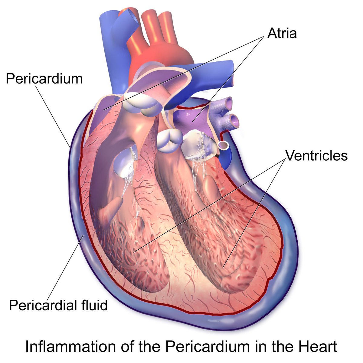 walinjom's tweet photo. Dressler syndrome: 

an autoimmune phenomenon that can occur after myocardial infarction and manifests 2-3 weeks later as pericarditis and a pericardial effusion. https://t.co/6XSrKPD0He