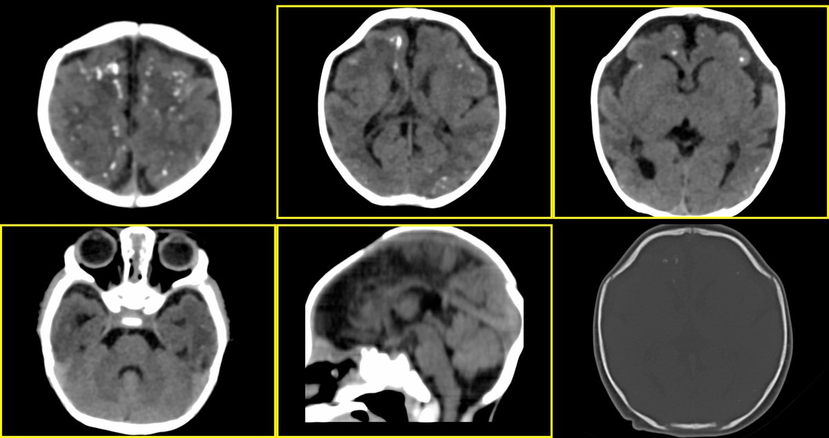 1 month F child with microcephaly and hypotonia, seizures. A systemic approach to neonatal neuroparenchymal calcifications and cortical malformations with a proper clinical examination for ancillary findings and symptoms. DOI: 10.1007/s00247-020-04721-1
DOI:…