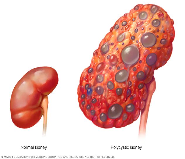 Good morning! Today is #WorldKidneyDay2024. I’m a mental health nurse living with stage 4 CKD thanks to polycystic kidney disease. Today I’m going to be tweeting about kidneys and MH meds! Stay tuned @ForPrescribing @PKDCharity