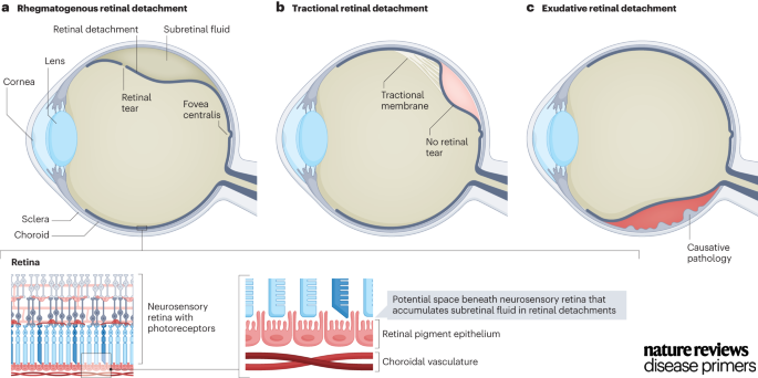 Our NEW Primer on Retinal detachment is live today! By @jonatlin, Narayanan, Philippakis, @YoshiYonekawaMD & Apte. Check it out here: go.nature.com/4acON6F