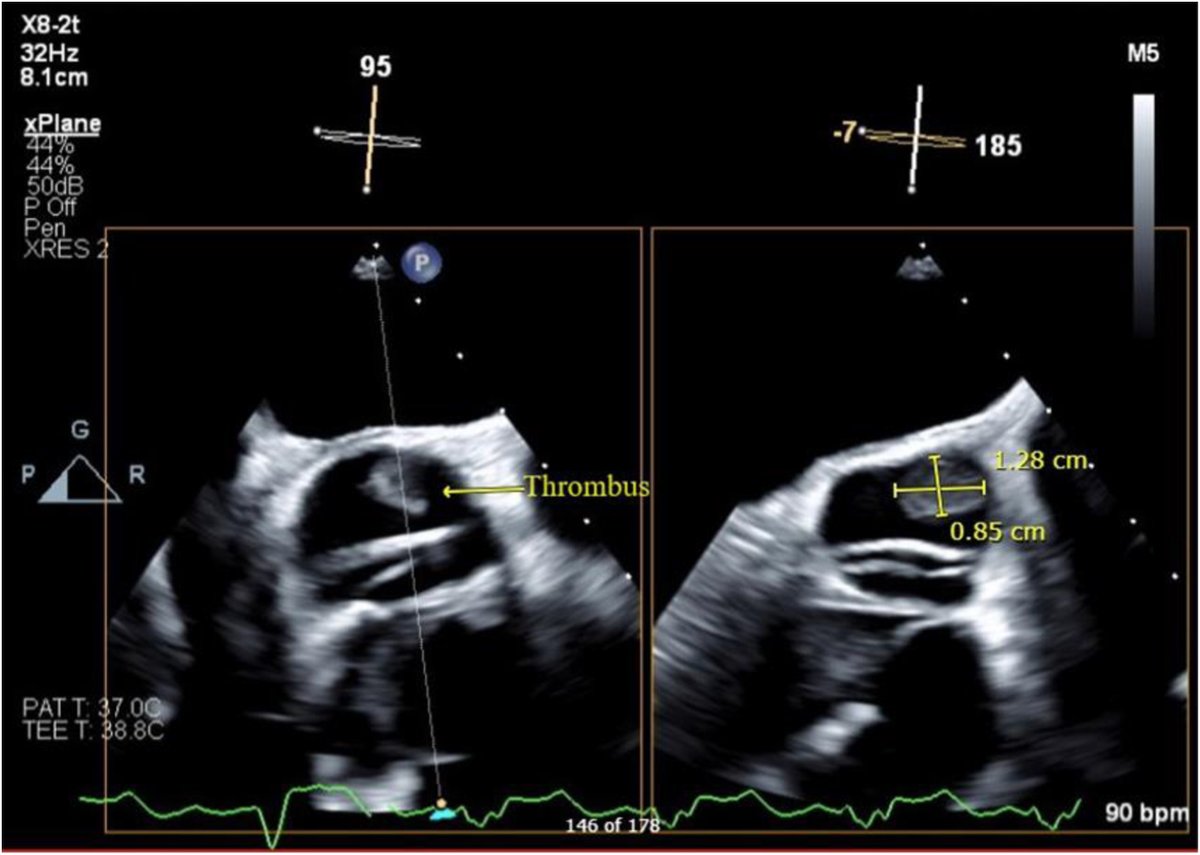 ASE360's tweet photo. We present a patient with repaired dextro-transposition of the great arteries (D-TGA) with Rastelli procedure and a possible long-term thrombotic complication. https://t.co/uZrDKSvkcc
#CASESpecialIssue #10DaysofCASE #ACHD https://t.co/YK8YeXBLNx