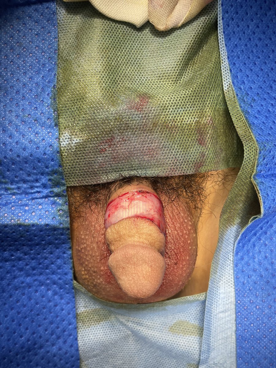 PlastiqueGEMIA's tweet photo. 这位先生15年前因过量切除包皮导致在完全勃起状态下皮肤紧绷且伴有疼痛，瘢痕也非常明显。 这种情况只做瘢痕切除再吻合是行不通的。我们在术中首先切除瘢痕，并根据皮肤缺损情况构造并转移阴囊中隔皮瓣恢复了阴茎原有的皮肤长度，改善了外观和舒适度。4周后二期手术断蒂将阴茎和阴囊再次分开。 https://t.co/wpn8HbtUKj