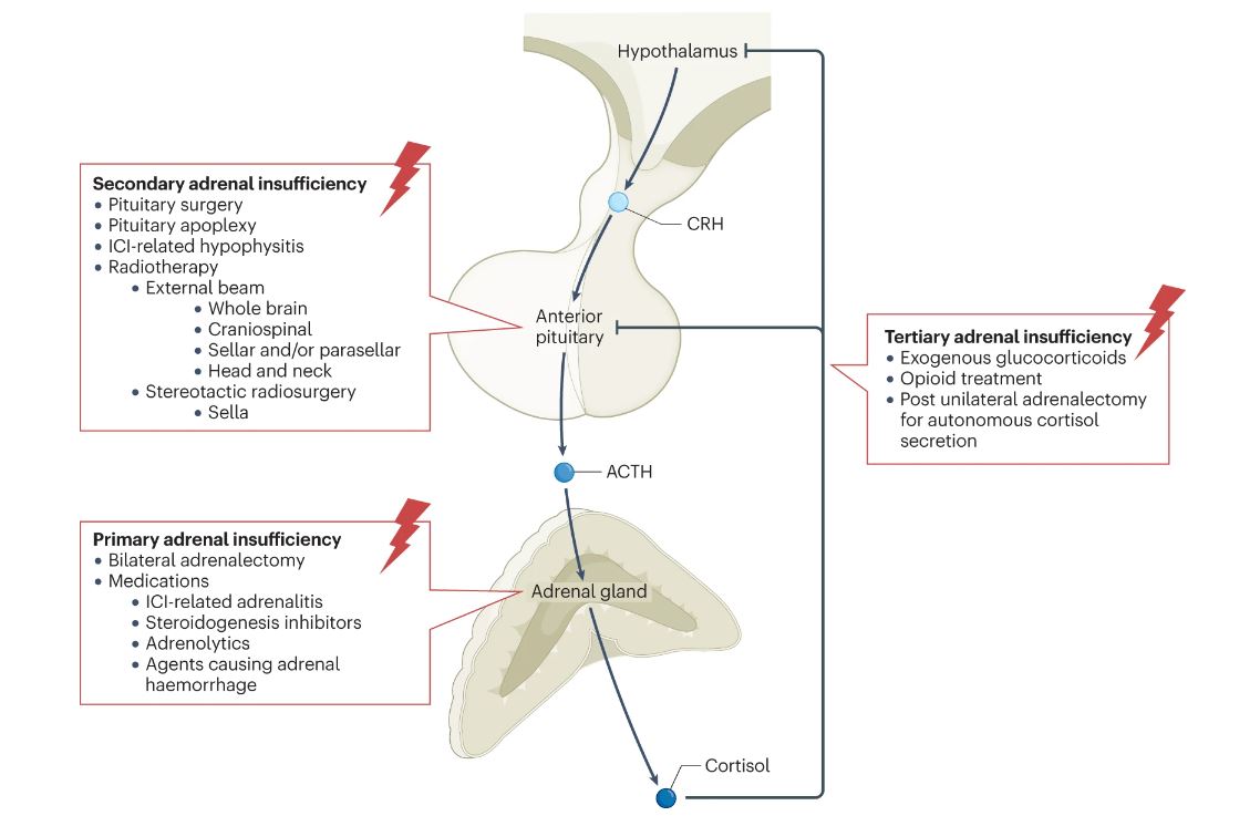 NatureRevEndo's tweet photo. Featured in our April issue: Mark Sherlock and colleagues discuss iatrogenic #adrenal insufficiency - risk factors, screening and treatment https://t.co/UsiBMom5dv https://t.co/8x4v1FwNEL