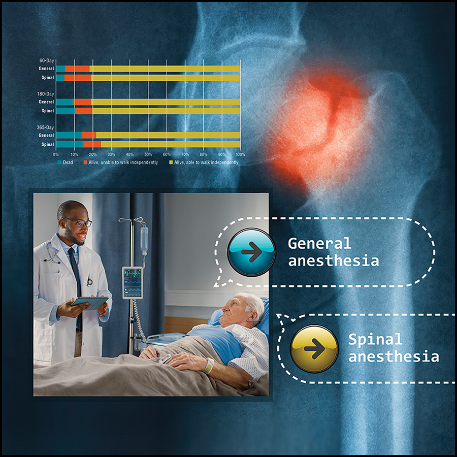 ASALifeline's tweet photo. The March @_Anesthesiology cover study found no meaningful difference in outcomes between spinal and general anesthesia for hip fracture surgery. The choice of anesthesia can thus be based on patient preference and operative planning. https://t.co/afAKPsBMSB 
  
#anesthesiologist https://t.co/s7oohclaZ2