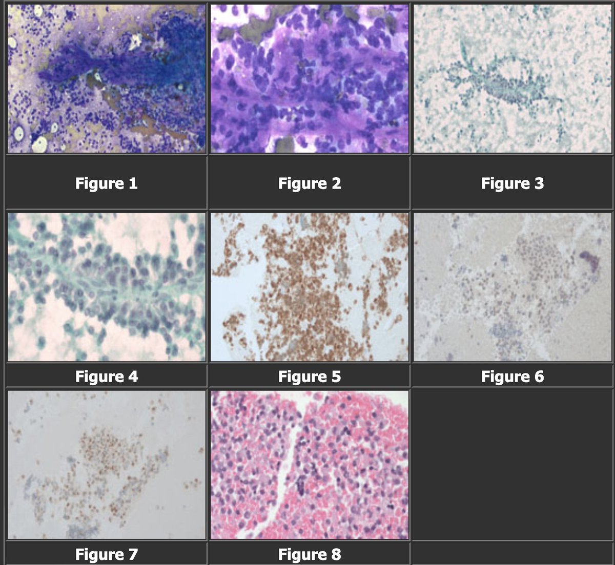 CASE OF THE MONTH @PapSociety. 58 F with abdominal pain. Imaging: 2.4 cm round, hypoechoic, calcified mass in the pancreatic tail without pancreatic duct dilation. An EUS-FNA of the pancreatic tail mass was performed. Pls see answer below. papsociety.com/cotm23/cotmaug… @IACytology