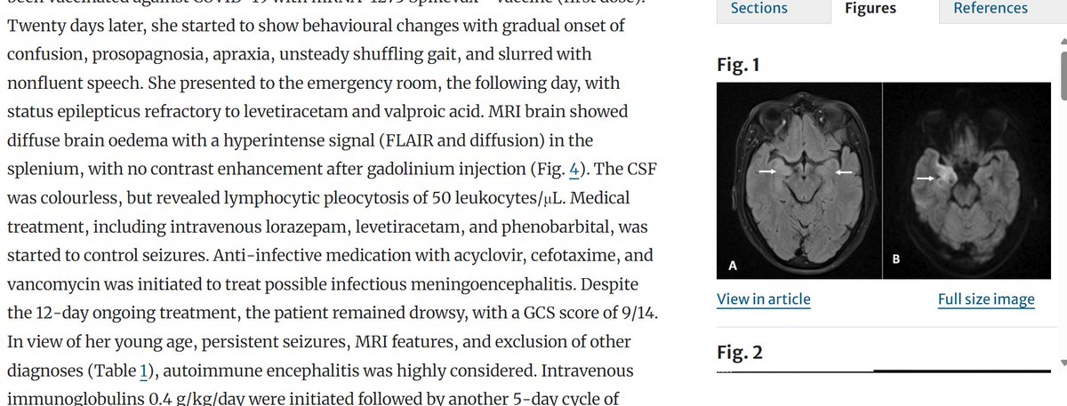 35-year-old female - 20 days after 1st dose #Moderna #mRNA vaccine started to show behavioural changes with gradual onset of confusion, prosopagnosia, apraxia, unsteady shuffling gait, and slurred with nonfluent speech.
link.springer.com/article/10.100…