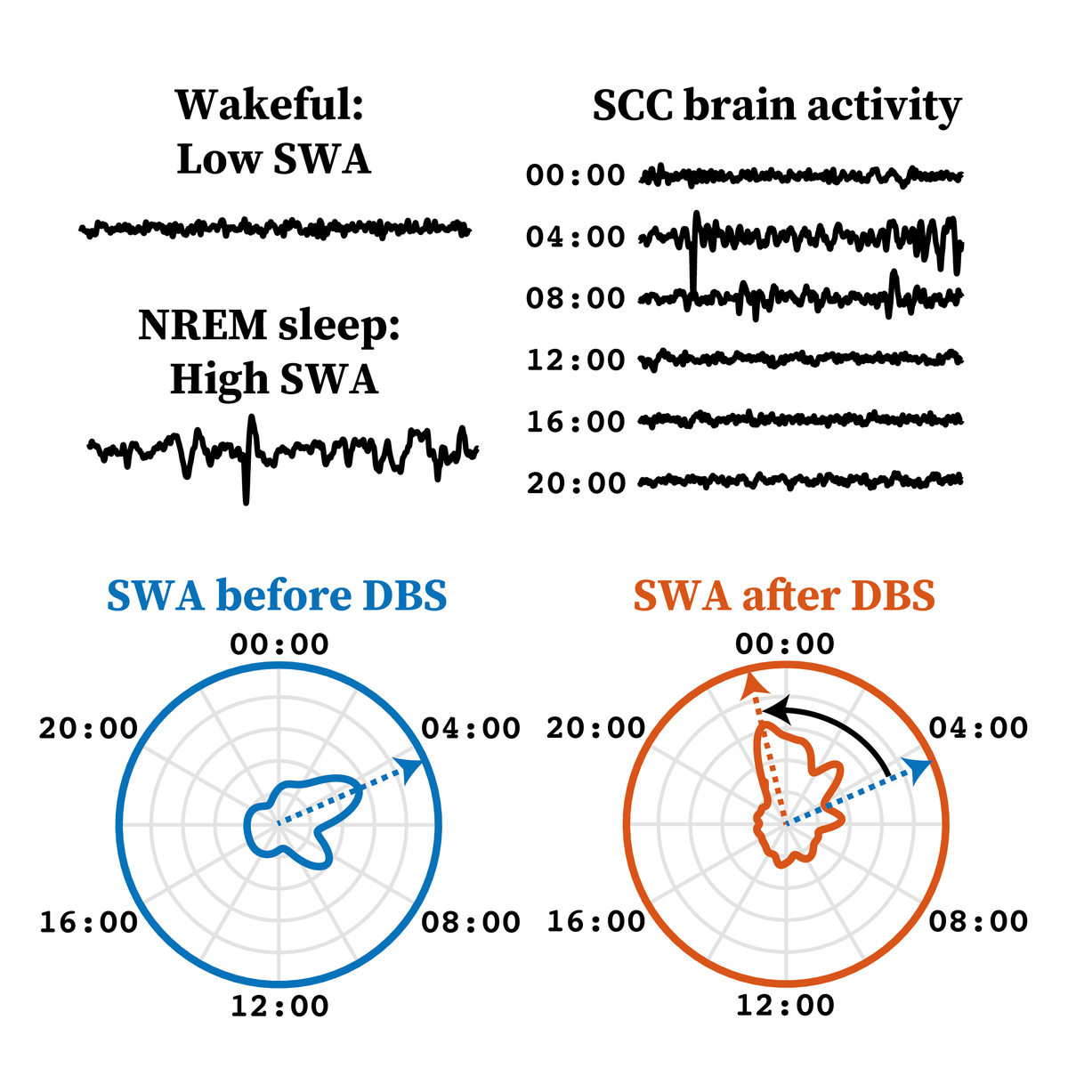 New Unit Paper in @Transl_Psych on the effect of deep brain stimulation in depression on cortical signatures of sleep mrcbndu.ox.ac.uk/publications/c… @MRCBNDU @NDCNOxford @UniofOxford