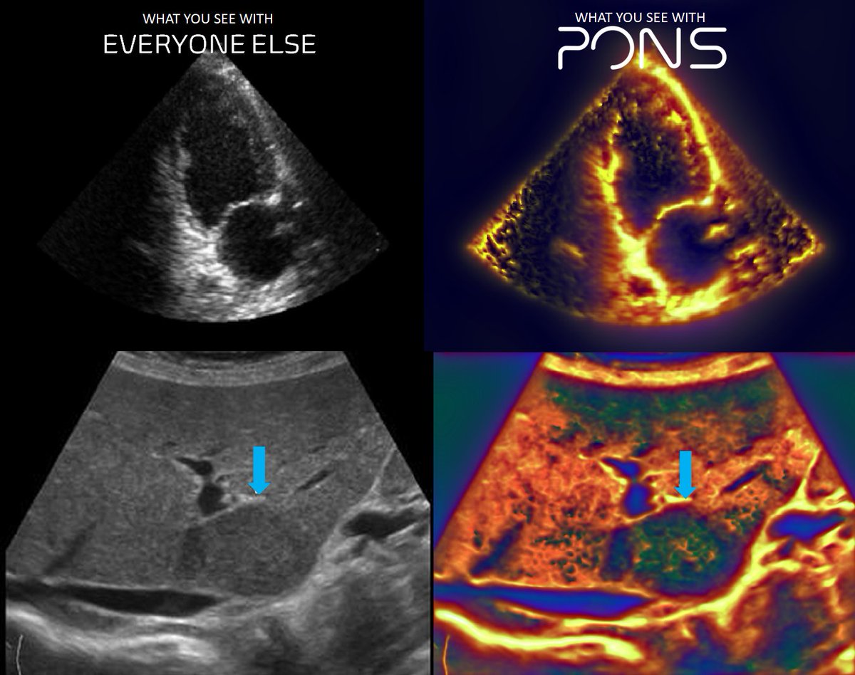 PONS: Transforming point-of-care ultrasound into a rich data source for continuous disease monitoring. We unlock novel biomarkers for early-stage disease progression, empowering pharmaceutical companies to develop targeted therapies #HIMSS24 #AI #HIMSS2024 #Bitcoin #digitalhealth