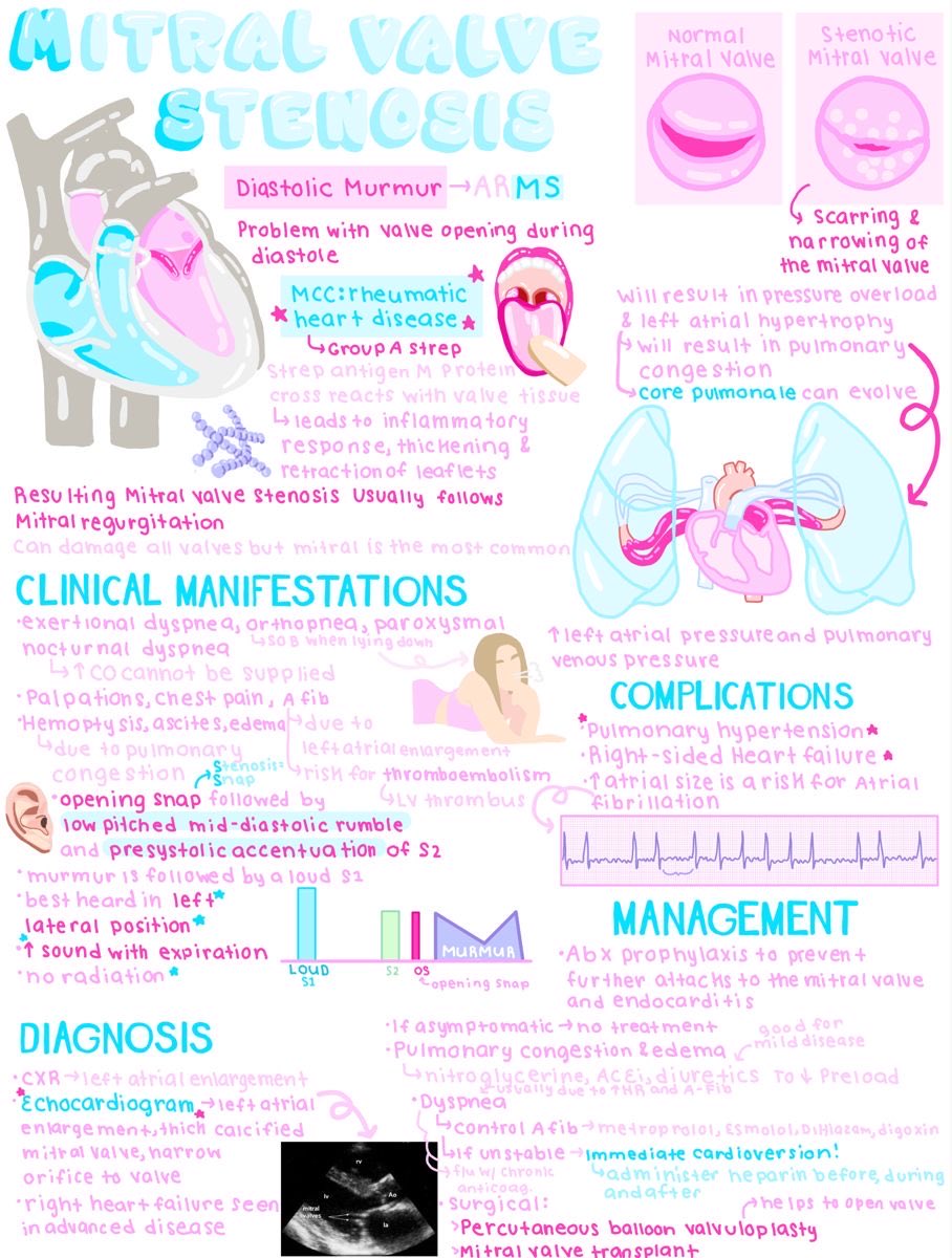 OGdukeneurosurg's tweet photo. Mitral valve stenosis by Allie https://t.co/JnFf2Tjczy