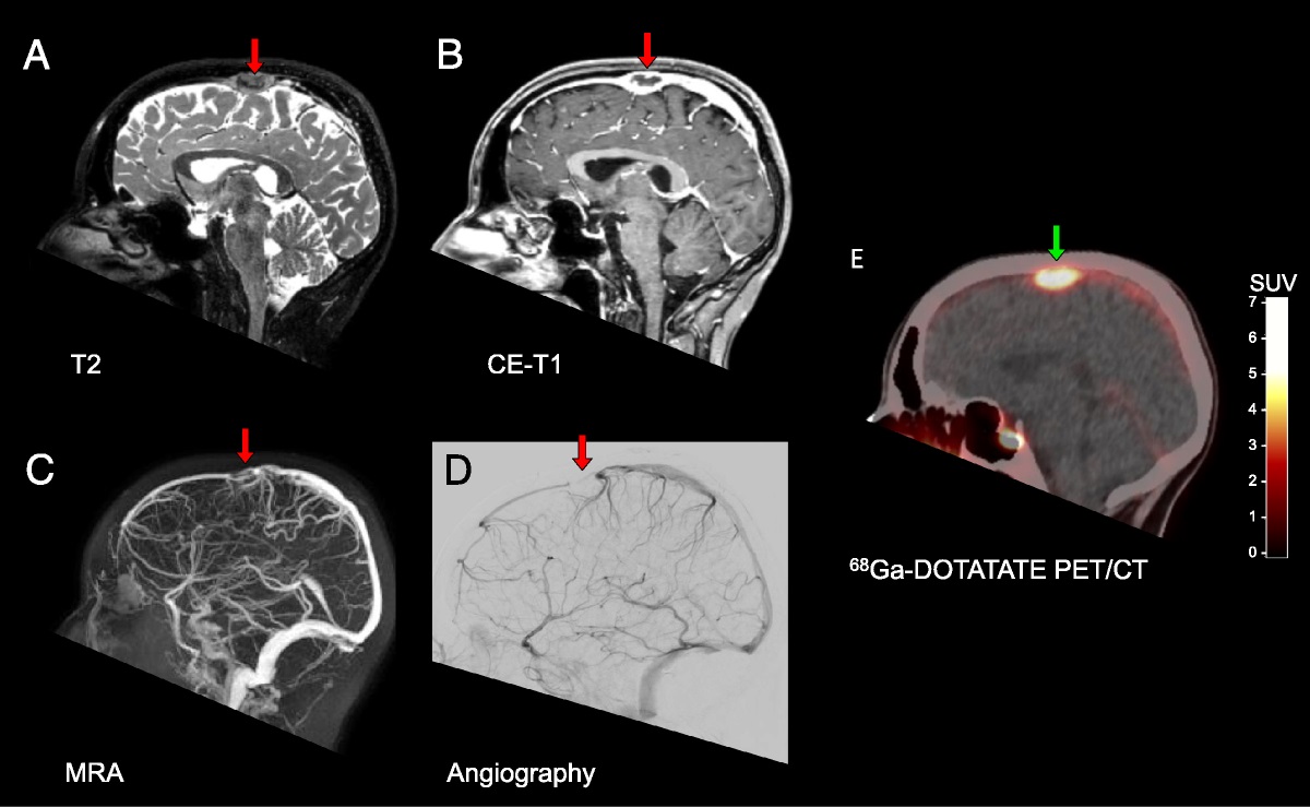 Current Issue: Differentiation of a Falcine Meningioma From Cerebral Venous Sinus Thrombosis Using DOTATATE PET dlvr.it/T43X5V