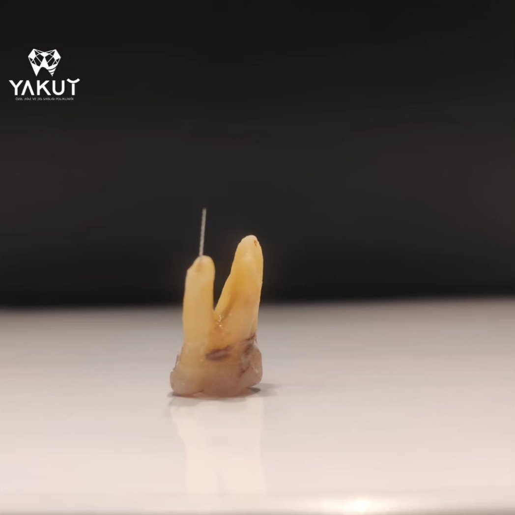 YakutDent's tweet photo. After undergoing previous endodontic treatment, the tooth unfortunately required extraction due to the presence of a broken instrument lodged inside
☎️ 00905527772020
  00902125236616
 #dentist #beauty #dentalcare  #smilemakeover #TEeThanapon #AamirKhan #USA #istanbul #tiktokban https://t.co/mfNd1qVmmA