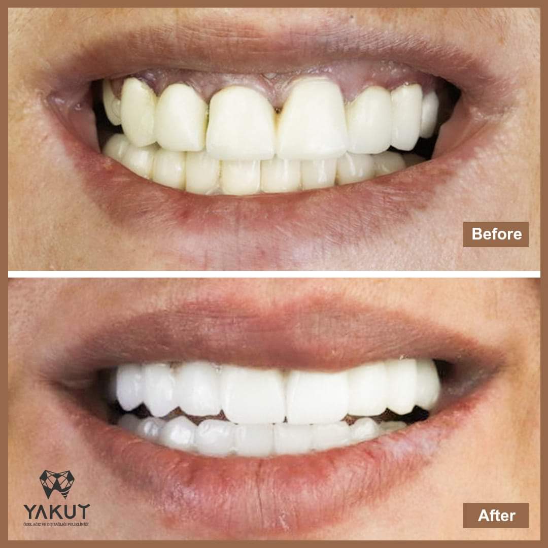YakutDent's tweet photo. Choose your luxury way with #Yakut_Dental_Clinic 

visit our website https://t.co/XPPEU27yoN

☎️ 00905527772020
  00902125236616 

#yakutdent #DentalImplants #SmileTransformation #cosmeticdentistry #smilemake #teethwhitening  #istanbul #turkiye #turkey 
#medicaltourism #KateGate https://t.co/36vQGzj2Ph