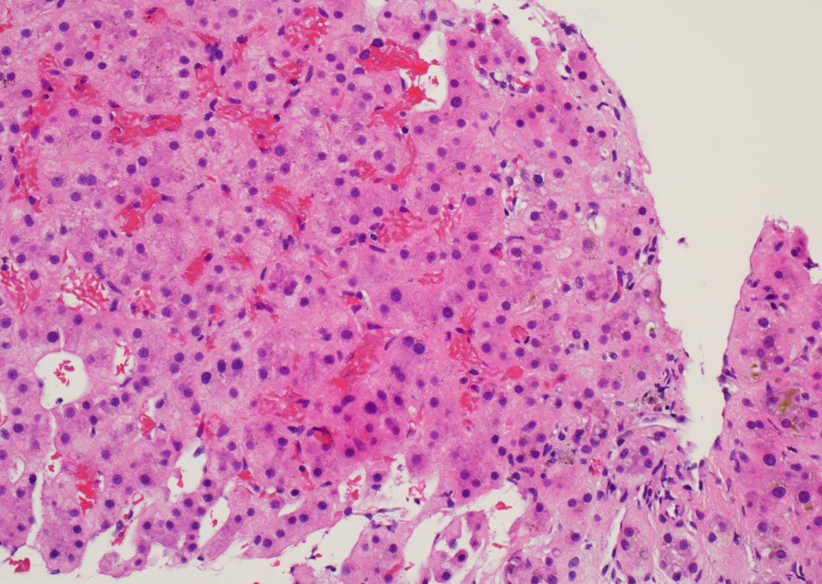 #PathResidents, describe what you 👀.  

Final diagnosis? 🔬🔬🔬

#GIpath #LiverPath #MedTwitter #Pathology #PathResEssentials #PathX #PathTwitter #path2path #pathmatch2024 #hepatology