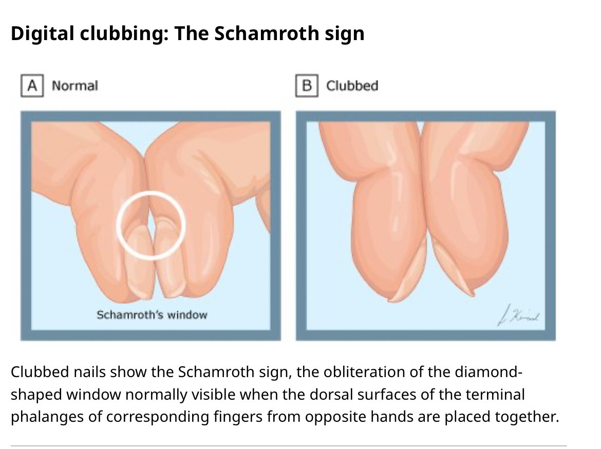 The distinction of normal and clubbed fingers. Note that the earliest... |  Download Scientific Diagram