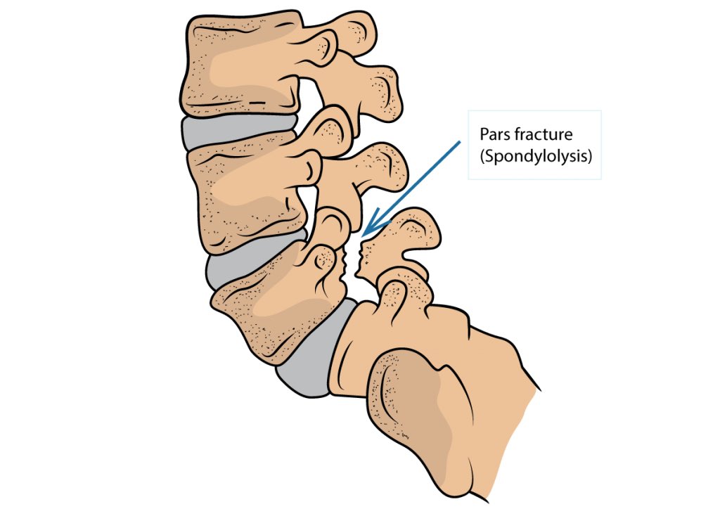 DrJesseMorse's tweet photo. Devin Williams 

Milwaukee Brewers 

Bilateral pars fracture at T12 

This is a back injury that is actually relatively common, especially in athletes. 

Athletes often visit Dr. Robert Watkins in California to get evaluated for back injuries, and that where Williams went.

The official medical term for this is Spondylolysis, sometimes it is referred to as a “pars defect” or "pars fracture."

This is considered a ‘stress fracture’ to a part of the vertebrae called the pars interarticularis, which connects the facet joints of the spine (see picture below). These are caused by repetitive stress rather than from an acute injury.

These are commonly seen in adolescent athletes such as gymnasts, where there is a great deal of extension and landing with an arched back. The arches back and hyperextension is likely where Williams got his from. 

Some people have a fracture only to 1 side, Williams actually fractured both sides, therefore it is actually called spondylolisthesis. This introduces additional concern because now the bone fragments are no longer attached to the rest of the bone. 

When fractures occur on both sides, it is possible for one vertebra to translate or move forward or backward over the neighboring vertebra, which creates further instability. It would not surprise me if Williams has some vertebrae that are shifted slightly forward or backward as a result of the stress fracture. 

The location of Williams’ fracture is actually interesting (T12). Normally these are seen at the bottom of the spine (L5), but due to the nature of Williams’ pitching style and maybe some intrinsic skeletal abnormalities (scoliosis) are likely the reasons why his fracture is the location it is. 

This is likely a chronic issue for Williams, and one that he was likely dealing with in September when he was dealing with back soreness. 

People dealing with these usually pain and stiffness in the lower back that is worsened with activity and improves with rest. Hyperextension (abnormal stretching) of the lower back will usually aggravate the area as it overloads the pars fracture.

Traditionally the initial treatment for these types of stress fractures is rest from activity and bracing, followed by physical therapy. 

Usually the symptoms of spondylolysis almost always respond favorably to physical therapy and activity modification, but in my opinion with bilateral fractures (spondylolisthesis), are much more difficult to stabilize.

At my clinic we have had success with these injuries by reinforcing the surrounding joints, ligaments and tendons by injecting either PRP (blood), or stem cells. Additionally we have had good success with using a PEMF device to aid in repair, which uses magnets to speed up fracture healing. 

Surgery with plate and/or screw placement would be counterproductive IMO for Williams because of the nature of his job. He needs the flexibility in this part of his spine in order to pitch the way he does.

Given the severity and importance of this location, shutting Williams down for 6 weeks and then ramping him up  for another 6 weeks is normal. Returning sometime around the All-Star break is realistic.

In my opinion this is something that Williams will always be dealing with but once it’s stabilized, it likely won’t bother him as much as it currently is. 
With that being said, I don’t think he will show any signs of injury once he’s learned to perform with this. 

He will have to regularly work on his body/pitching mechanics to ensure that this fracture isn’t returning. 

I discussed further in a video in the tweet below if you’re interested. 

If you found this tweet helpful and informative, please share this with your friends and consider following along for more injury-related content. 

This is produced as part of the @TheFantasyDRS network.