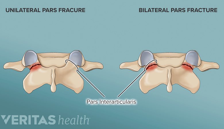 DrJesseMorse's tweet photo. Devin Williams 

Milwaukee Brewers 

Bilateral pars fracture at T12 

This is a back injury that is actually relatively common, especially in athletes. 

Athletes often visit Dr. Robert Watkins in California to get evaluated for back injuries, and that where Williams went.

The official medical term for this is Spondylolysis, sometimes it is referred to as a “pars defect” or "pars fracture."

This is considered a ‘stress fracture’ to a part of the vertebrae called the pars interarticularis, which connects the facet joints of the spine (see picture below). These are caused by repetitive stress rather than from an acute injury.

These are commonly seen in adolescent athletes such as gymnasts, where there is a great deal of extension and landing with an arched back. The arches back and hyperextension is likely where Williams got his from. 

Some people have a fracture only to 1 side, Williams actually fractured both sides, therefore it is actually called spondylolisthesis. This introduces additional concern because now the bone fragments are no longer attached to the rest of the bone. 

When fractures occur on both sides, it is possible for one vertebra to translate or move forward or backward over the neighboring vertebra, which creates further instability. It would not surprise me if Williams has some vertebrae that are shifted slightly forward or backward as a result of the stress fracture. 

The location of Williams’ fracture is actually interesting (T12). Normally these are seen at the bottom of the spine (L5), but due to the nature of Williams’ pitching style and maybe some intrinsic skeletal abnormalities (scoliosis) are likely the reasons why his fracture is the location it is. 

This is likely a chronic issue for Williams, and one that he was likely dealing with in September when he was dealing with back soreness. 

People dealing with these usually pain and stiffness in the lower back that is worsened with activity and improves with rest. Hyperextension (abnormal stretching) of the lower back will usually aggravate the area as it overloads the pars fracture.

Traditionally the initial treatment for these types of stress fractures is rest from activity and bracing, followed by physical therapy. 

Usually the symptoms of spondylolysis almost always respond favorably to physical therapy and activity modification, but in my opinion with bilateral fractures (spondylolisthesis), are much more difficult to stabilize.

At my clinic we have had success with these injuries by reinforcing the surrounding joints, ligaments and tendons by injecting either PRP (blood), or stem cells. Additionally we have had good success with using a PEMF device to aid in repair, which uses magnets to speed up fracture healing. 

Surgery with plate and/or screw placement would be counterproductive IMO for Williams because of the nature of his job. He needs the flexibility in this part of his spine in order to pitch the way he does.

Given the severity and importance of this location, shutting Williams down for 6 weeks and then ramping him up  for another 6 weeks is normal. Returning sometime around the All-Star break is realistic.

In my opinion this is something that Williams will always be dealing with but once it’s stabilized, it likely won’t bother him as much as it currently is. 
With that being said, I don’t think he will show any signs of injury once he’s learned to perform with this. 

He will have to regularly work on his body/pitching mechanics to ensure that this fracture isn’t returning. 

I discussed further in a video in the tweet below if you’re interested. 

If you found this tweet helpful and informative, please share this with your friends and consider following along for more injury-related content. 

This is produced as part of the @TheFantasyDRS network.