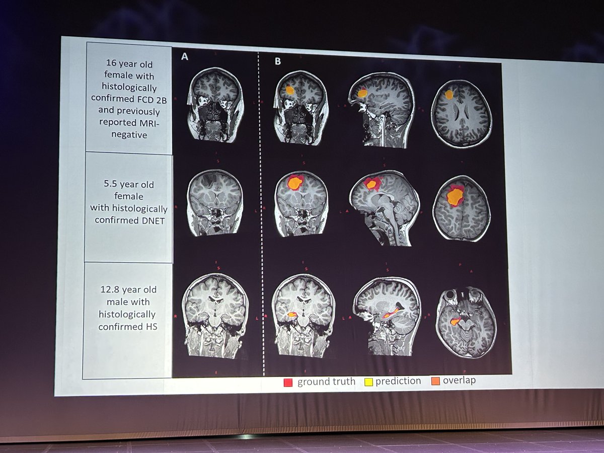 ✨Sophie Adler's fascinating talk about 'Interpretation of clinical MRI in #Epilepsy using artificial intelligence' e.g. 💻In @meld_project anonymised MRI scan from patient with focal epilepsy, where in the #brain is causing the #seizure @UEF_BRU #KES2024 #kuopioepilepsy @ucl