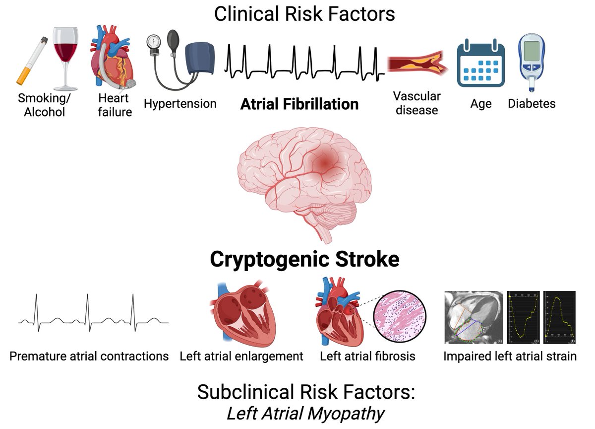 In this @JACCJournals #JACCAdvances editorial, @RBPatelMD and I discuss the clinical and subclinical risk factors a/w cryptogenic stroke. Given the relationship between AF and stroke, impt to appropriately adjudicate AF clinically, and in future studies authors.elsevier.com/sd/article/S27…