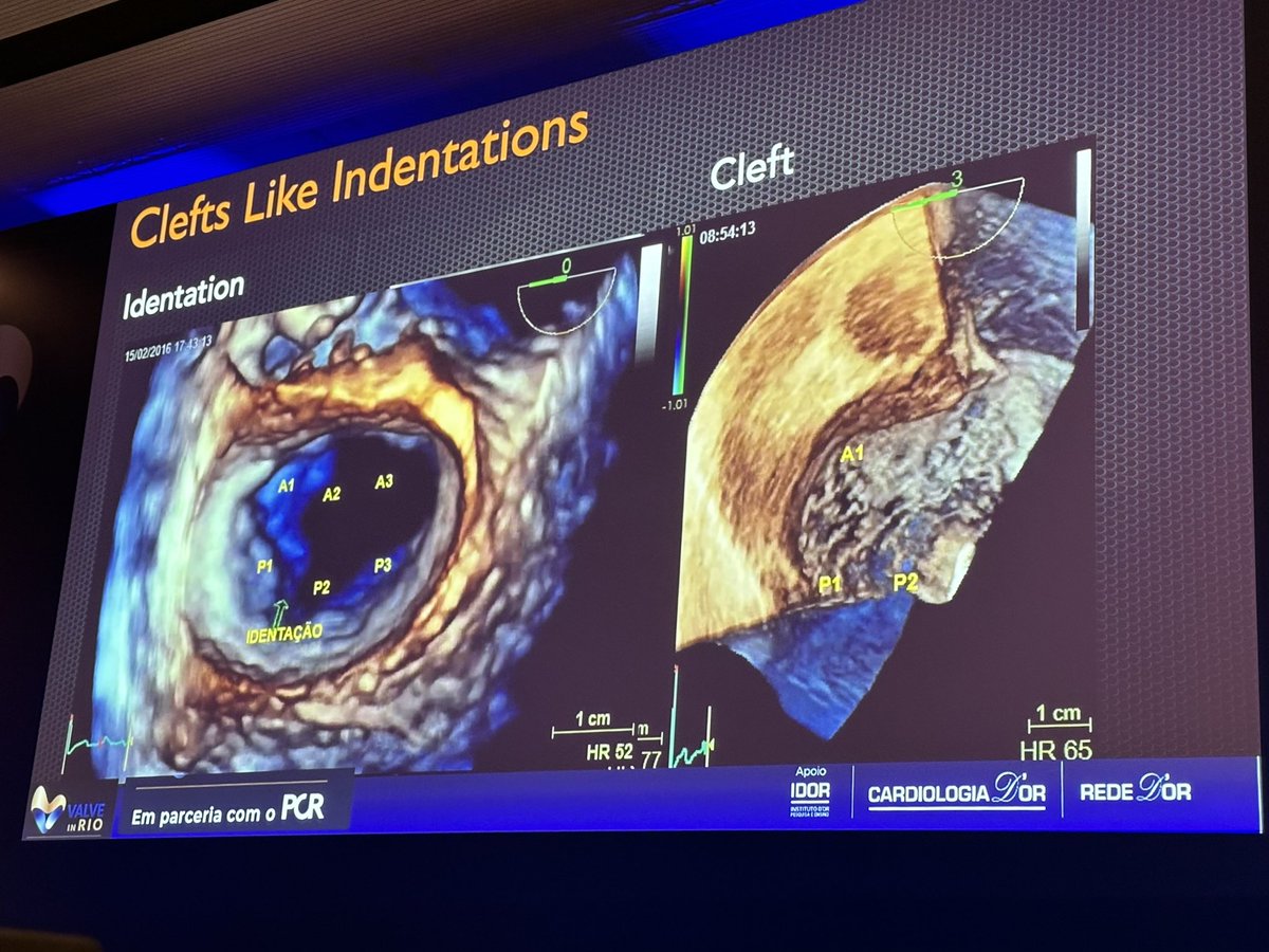 hahn_rt's tweet photo. What a beautiful talk on Mitral Valve Anatomy by Monica Luiza de Alcantara #ValveinRio @vinesteves @lpbadano @modine_thomas https://t.co/S7PorVJat5