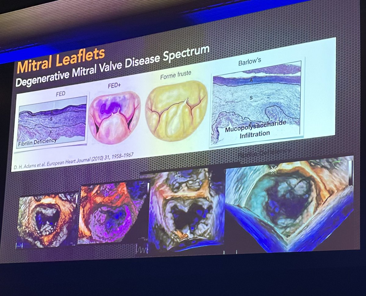 hahn_rt's tweet photo. What a beautiful talk on Mitral Valve Anatomy by Monica Luiza de Alcantara #ValveinRio @vinesteves @lpbadano @modine_thomas https://t.co/S7PorVJat5