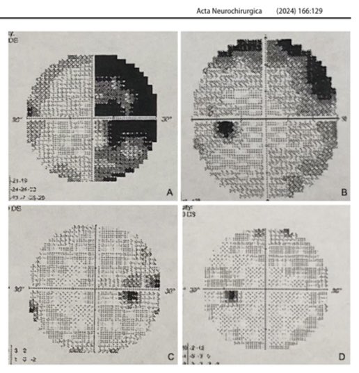 Guilherme Finger (@guilherme_fngr) on Twitter photo Honored to see our technique to decompress the optic nerve through EEA published at <a href="/ActaNeuro/">Acta Neurochirurgica</a>. The opening of the optic canal and the optic nerve sheath allows a successful decompression of the nerve and, consequently, significant improvement of the vision. <a href="/PrevedelloDanny/">Danny Prevedello</a> Honored to see our technique to decompress the optic nerve through EEA published at <a href="/ActaNeuro/">Acta Neurochirurgica</a>. The opening of the optic canal and the optic nerve sheath allows a successful decompression of the nerve and, consequently, significant improvement of the vision. <a href="/PrevedelloDanny/">Danny Prevedello</a>