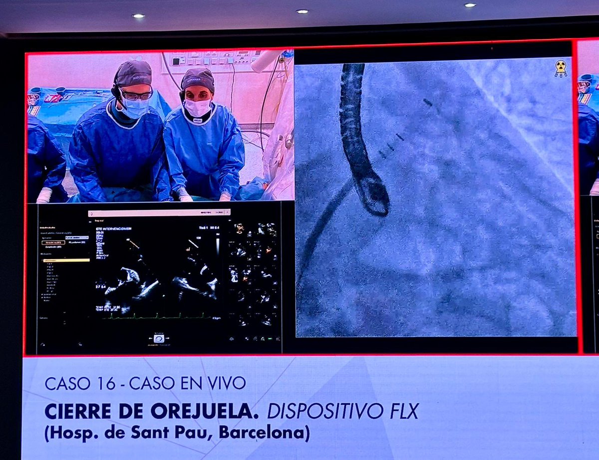 Caso muy interesante de cierre de orejuela en el curso CSC24. VersaCross RF con vaina deformable y guía floppy con FR para transeptal preciso! y big big watchman Flx para orejuela muy grande. El CT TruePlan ayudó!. Gracias @BSC_EU_Heart @StructuralBCN @icsMillan @CHPedroLi