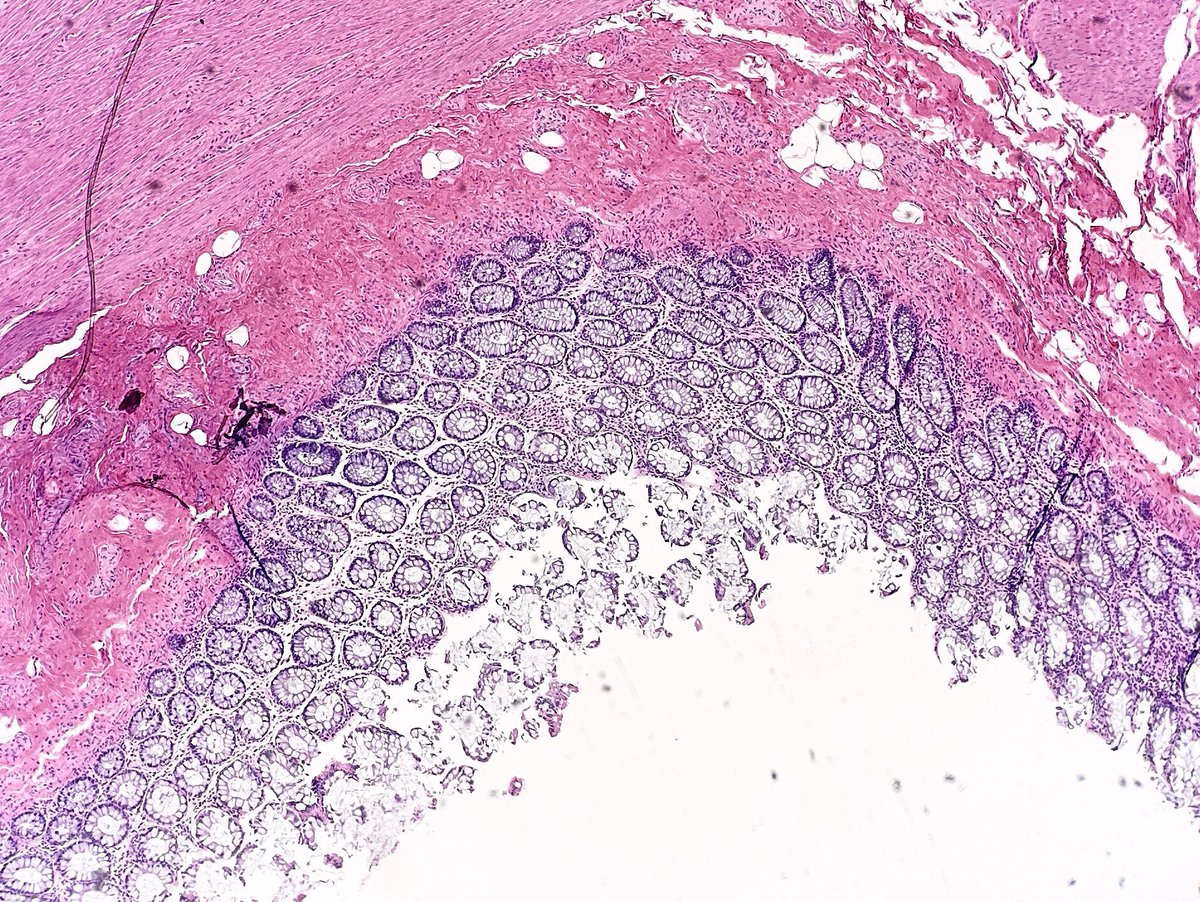 Path4People's tweet photo. 60 y/o F with breast cancer
On chemotherapy
Has N/V/D and colonoscopy and biopsy done β¬οΈ
What medicine might she be on based on histologic finding?
#pathagonia #pathx #gipath #gi #hemeonc #colitis #medx #medicine #oncology #pathology #surgpath #medicationeffect #pharmx https://t.co/3xMvOrOU5Y