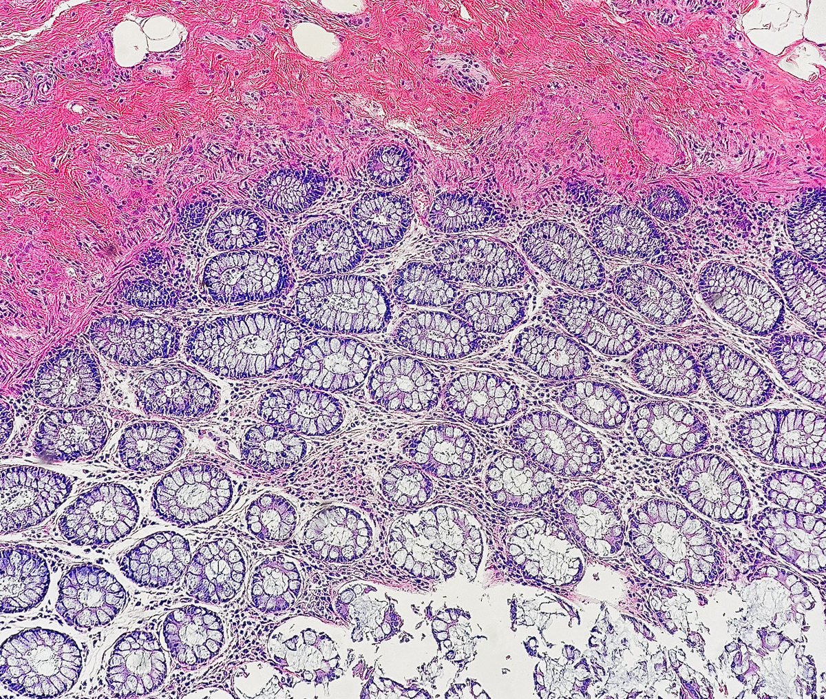 Path4People's tweet photo. 60 y/o F with breast cancer
On chemotherapy
Has N/V/D and colonoscopy and biopsy done β¬οΈ
What medicine might she be on based on histologic finding?
#pathagonia #pathx #gipath #gi #hemeonc #colitis #medx #medicine #oncology #pathology #surgpath #medicationeffect #pharmx https://t.co/3xMvOrOU5Y