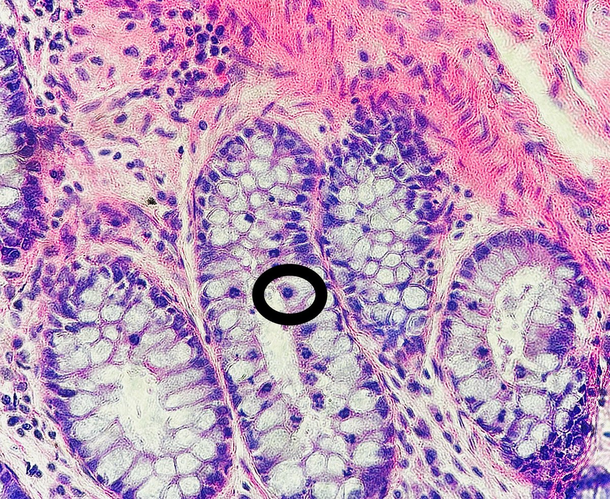 Path4People's tweet photo. 60 y/o F with breast cancer
On chemotherapy
Has N/V/D and colonoscopy and biopsy done β¬οΈ
What medicine might she be on based on histologic finding?
#pathagonia #pathx #gipath #gi #hemeonc #colitis #medx #medicine #oncology #pathology #surgpath #medicationeffect #pharmx https://t.co/3xMvOrOU5Y