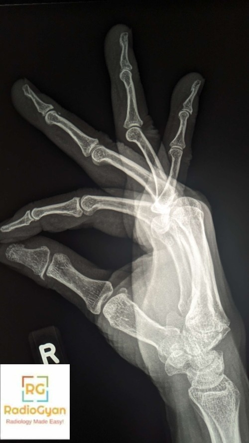 Hx: Swelling along the dorsal wrist. Answer: bit.ly/3ICuq7d #RGcases #radiogyan #radiology #radres #radiologia #FOAMrad #FOAMed